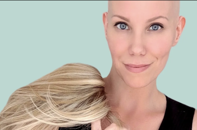 Redefining Beauty: Empowering Women Living With Alopecia